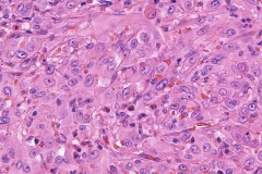 Epithelioid angiosarcoma