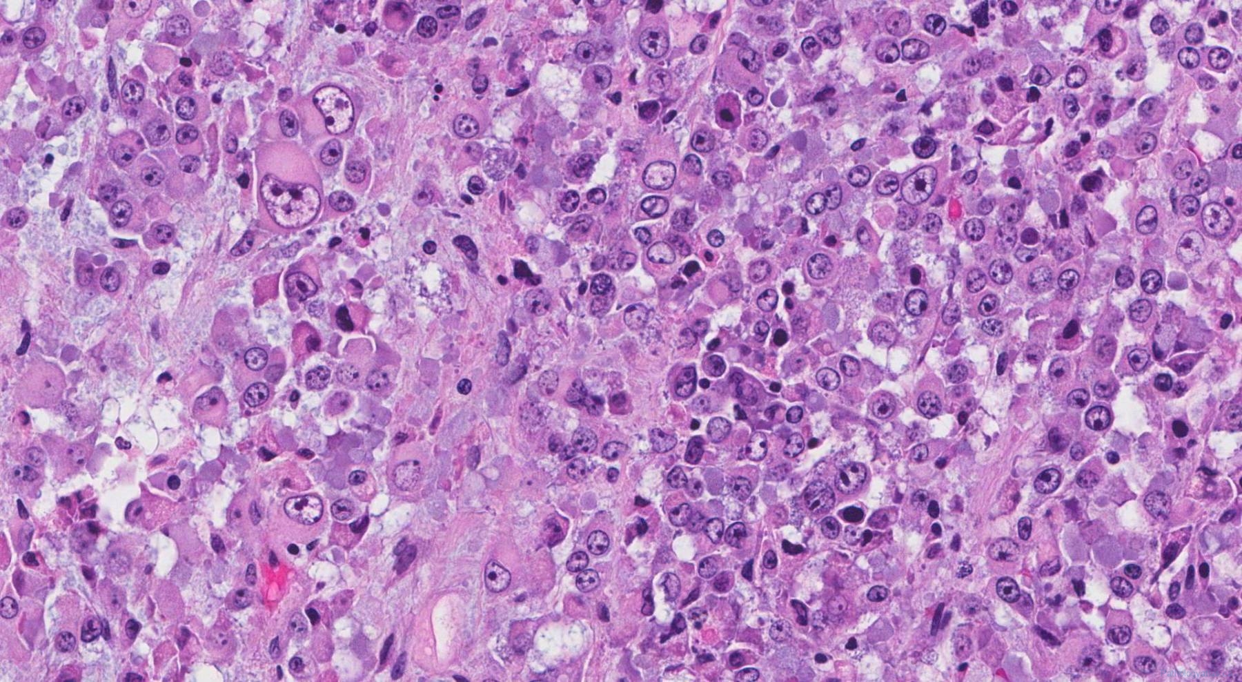 Epithelioid Sarcoma Atlas Of Pathology