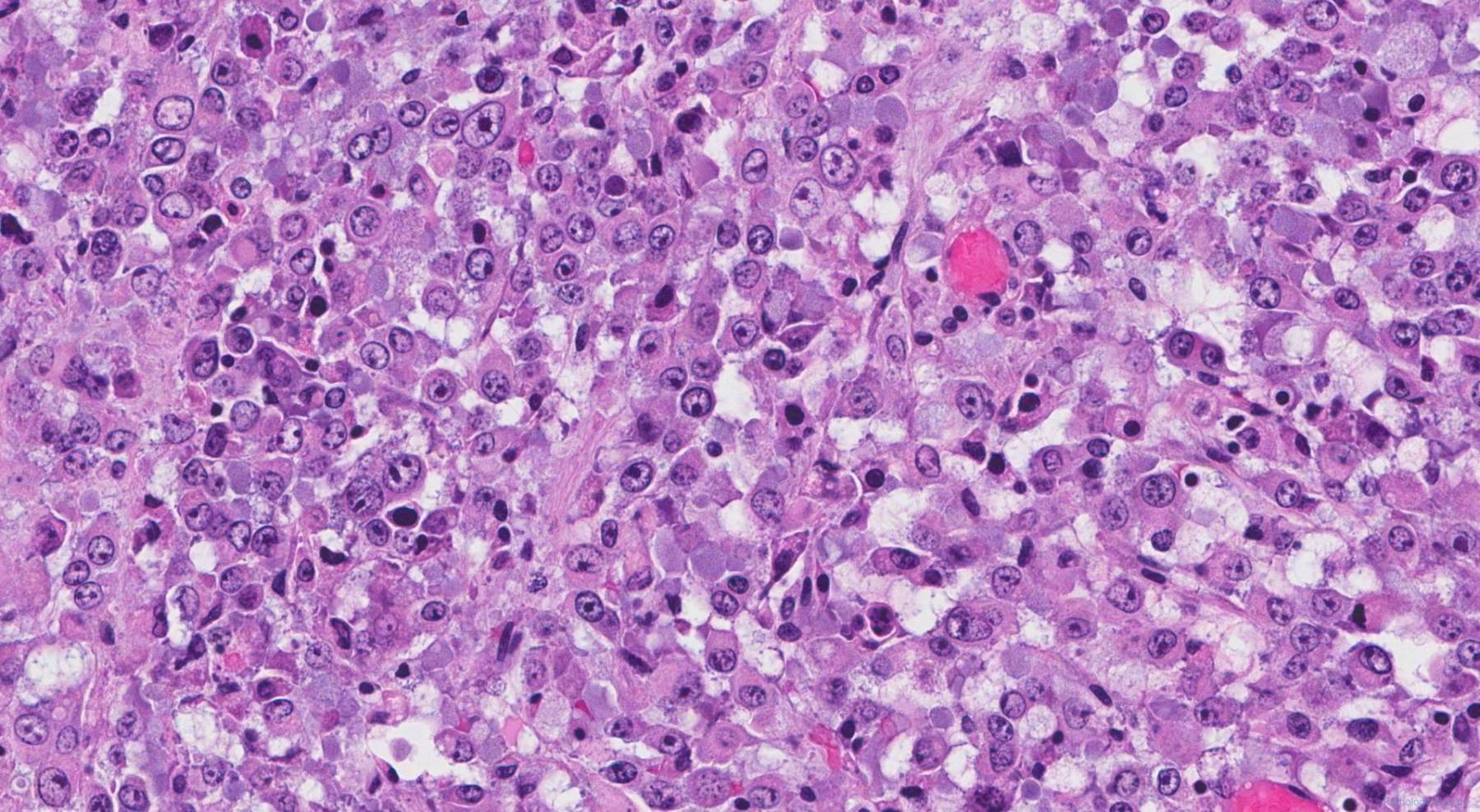 What Is Epithelioid Sarcoma Cancer EYEWO