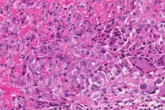 Epithelioid sarcoma