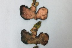 Extranodal marginal zone lymphoma arising in the thyroid gland