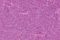 Extraosseous Ewings sarcoma