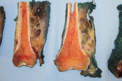 Extraskeletal myxoid chondrosarcoma surrounding the femur