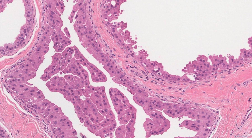 Apocrine metaplasia of the breast