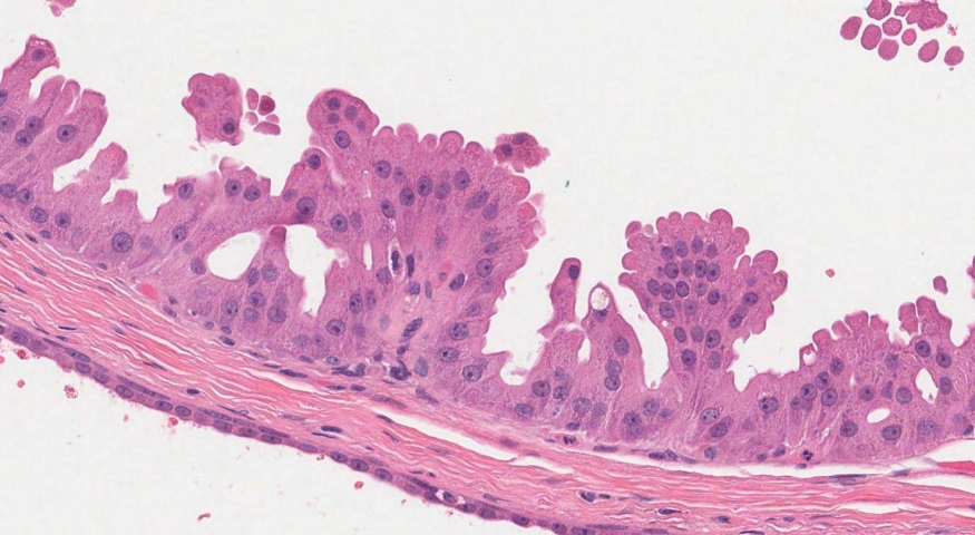 Apocrine metaplasia of the breast