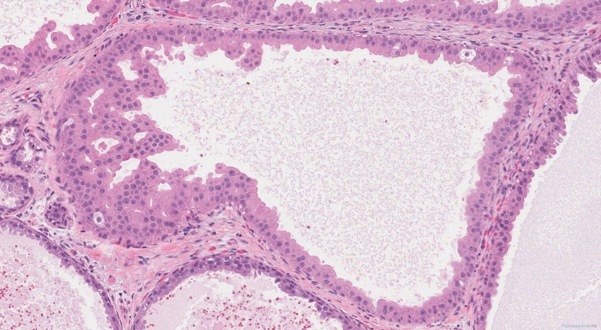 Apocrine metaplasia of the breast