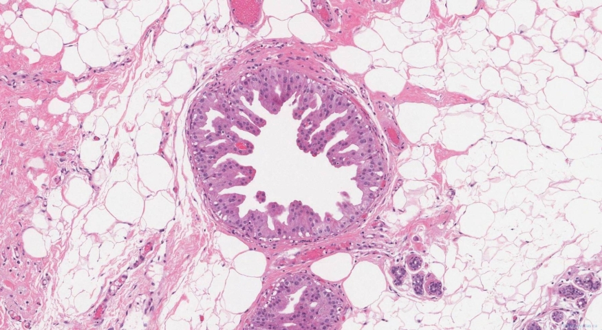 Apocrine metaplasia in the breast