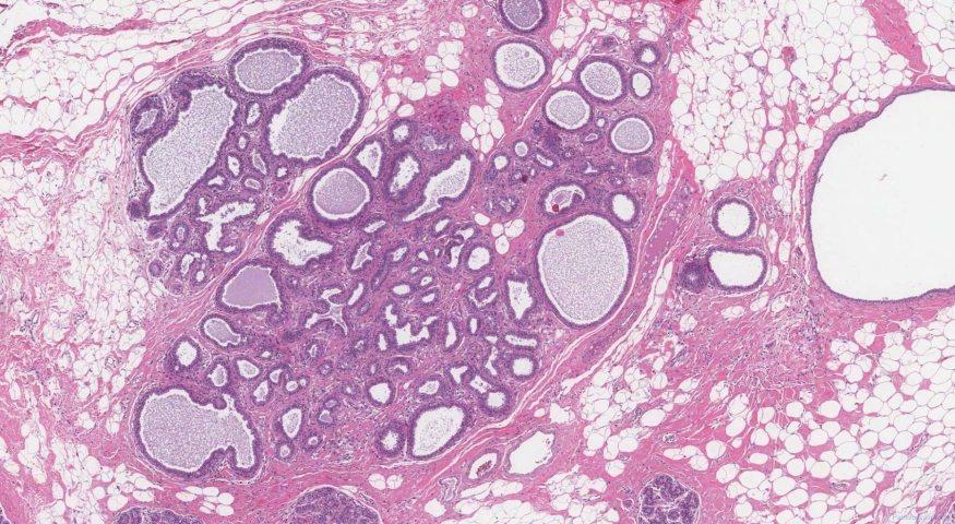 Fibrocystic disease in the breast