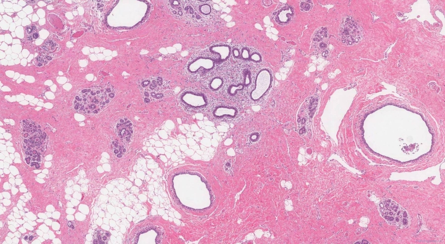 Fibrocystic disease in the breast