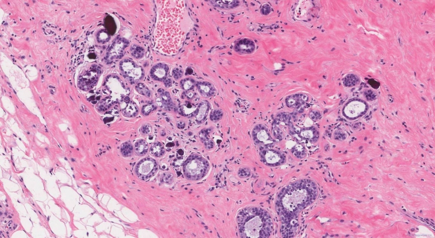 Microcalcifications in the breast