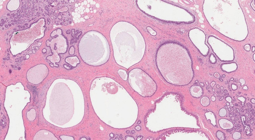 Duct ectasia of the breast