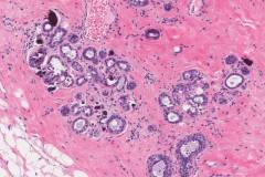 Microcalcifications in the breast