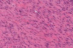 Fibromatosis of the breast
