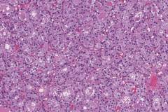 Follicular thyroid adenoma