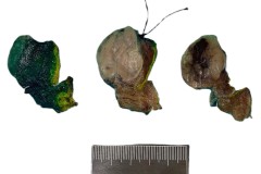 Follicular adenoma of the thyroid gland