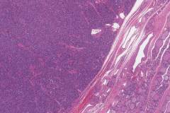 Follicular thyroid adenoma