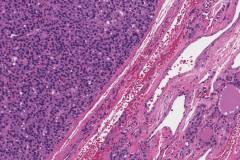 Follicular thyroid adenoma