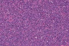 Follicular thyroid adenoma