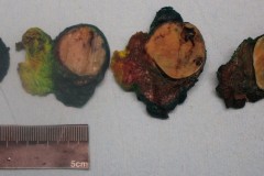 Follicular adenoma of the thyroid gland