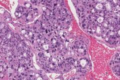 Metastatic follicular thyroid carcinoma to bone