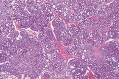 Metastatic follicular thyroid carcinoma to bone