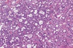 Metastatic follicular thyroid carcinoma to bone