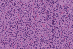 Follicular thyroid carcinoma of the thyroid gland