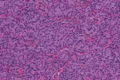 Follicular thyroid carcinoma of the thyroid gland
