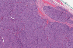 Follicular thyroid carcinoma of the thyroid gland
