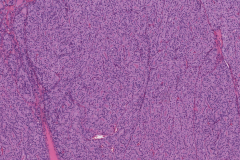 Follicular thyroid carcinoma of the thyroid gland