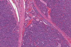 Follicular thyroid carcinoma of the thyroid gland