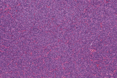 Follicular thyroid carcinoma of the thyroid gland