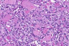Follicular variant papillary thyroid carcinoma