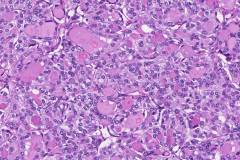 Follicular variant papillary thyroid carcinoma