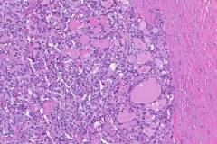 Follicular variant papillary thyroid carcinoma
