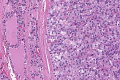 Follicular variant papillary thyroid carcinoma