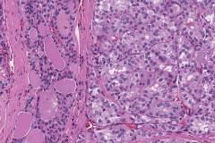 Follicular variant papillary thyroid carcinoma