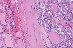 Follicular variant papillary thyroid carcinoma