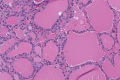 Follicular variant papillary thyroid carcinoma