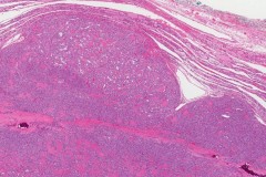 Follicular variant papillary thyroid carcinoma