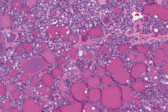 Follicular variant papillary thyroid carcinoma