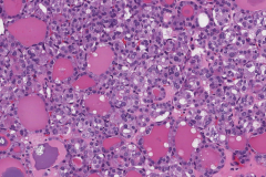 Follicular variant papillary thyroid carcinoma