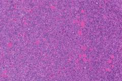 Follicular variant papillary thyroid carcinoma