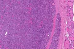 Follicular variant papillary thyroid carcinoma