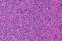 Follicular variant papillary thyroid carcinoma