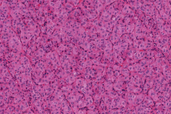 Follicular variant papillary thyroid carcinoma