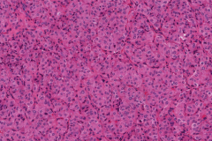 Follicular variant papillary thyroid carcinoma