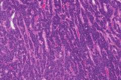 Follicular variant papillary thyroid carcinoma with transformation to poorly differentiated thyroid carcinoma