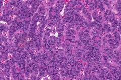 Follicular variant papillary thyroid carcinoma with transformation to poorly differentiated thyroid carcinoma