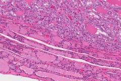 Follicular variant papillary thyroid carcinoma